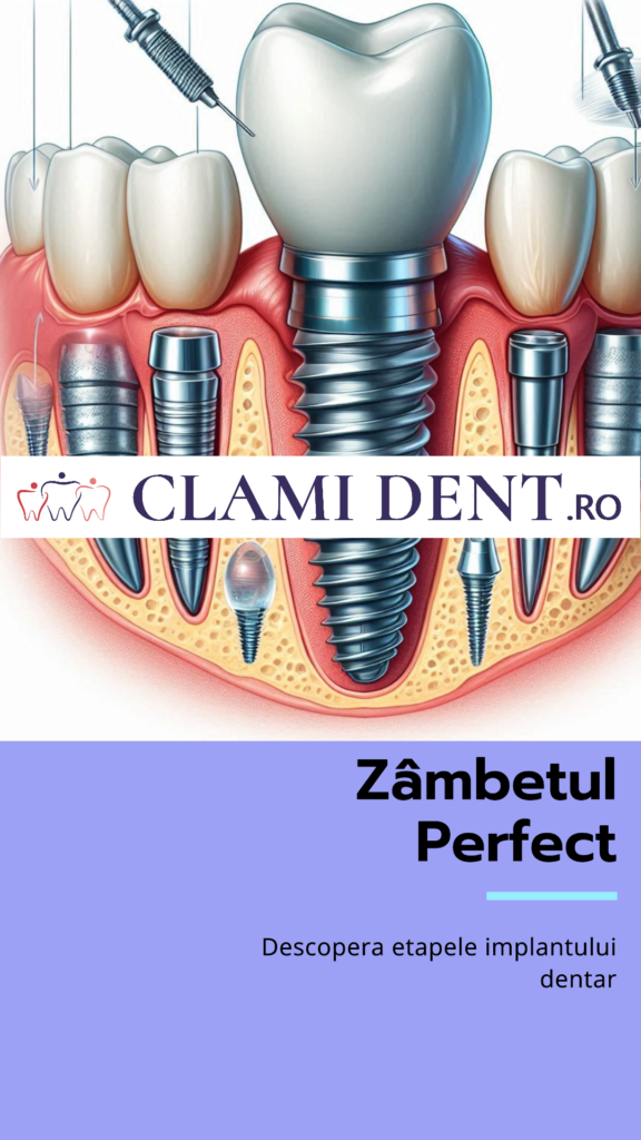 Procedura de Implant Dentar Explicată Pas cu Pas