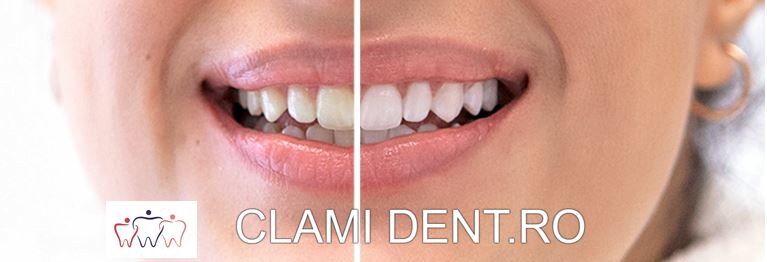 Albirea internă a dinților este o tehnică specială de estetică dentară folosită pentru a îmbunătăți culoarea dinților care au devenit decolorați din cauze interne,