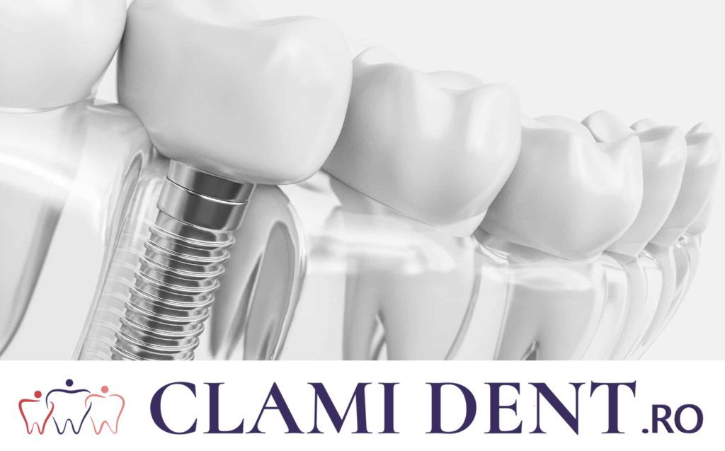 Cât Costă un Implant Dentar în 2024 Alba Iulia Clinica Stomatologica ClamiDent