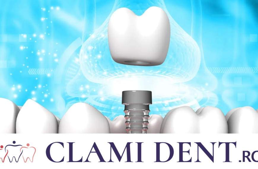 Cât Costă un Implant Dentar în 2024 Alba Iulia Clinica Stomatologica ClamiDent