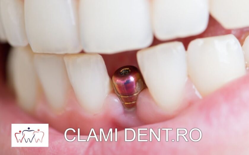 Cat costă un implant dentar in Alba Iulia Clami Dent