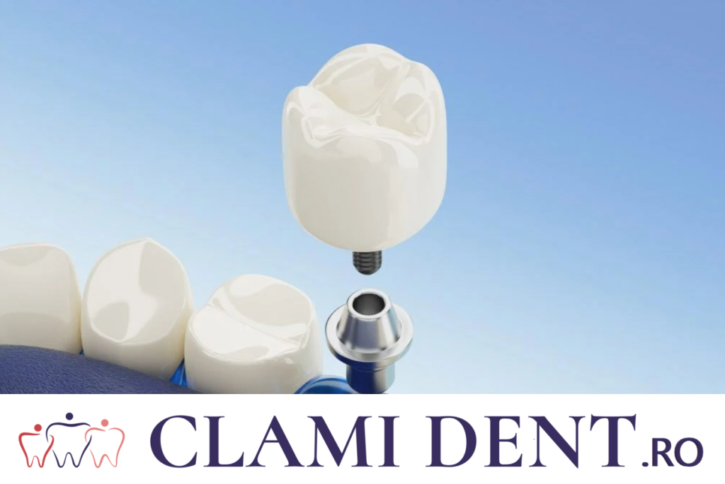 Curățarea implanturilor Alba Iulia Clinica Stomatologica ClamiDent