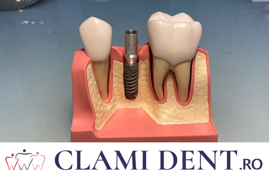 Curatarea-implanturilor-Alba-Iulia-Clinica-Stomatologica-ClamiDent