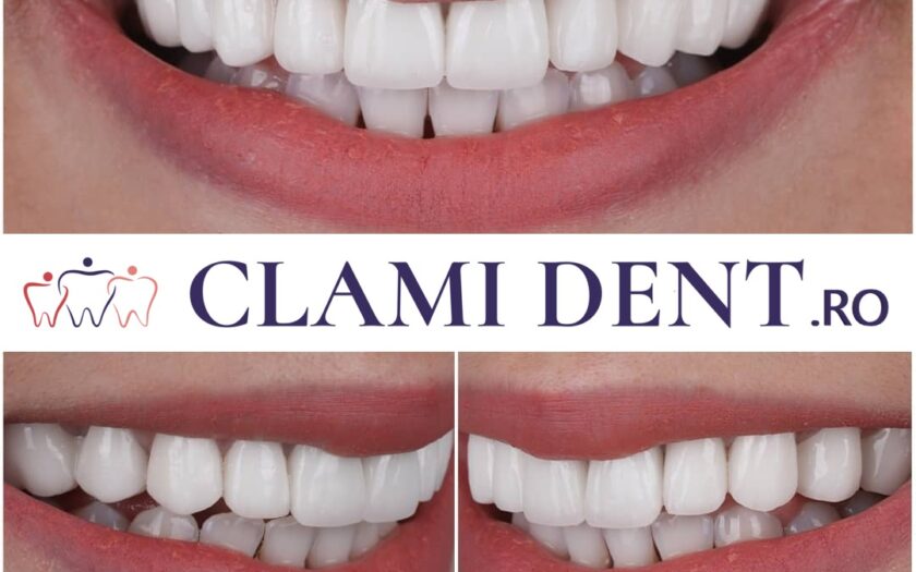 Implant dentar cost