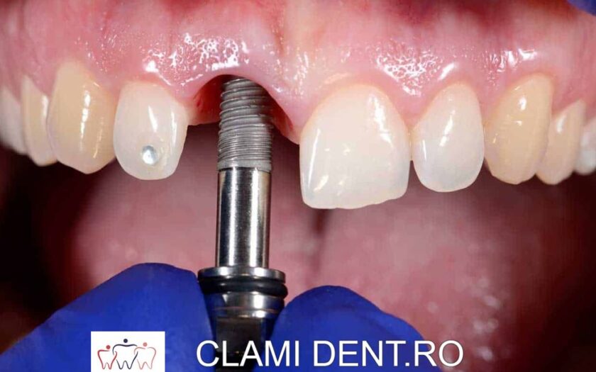 Implanturi Dentare Clinica Stomatologică Clamident Alba Iulia