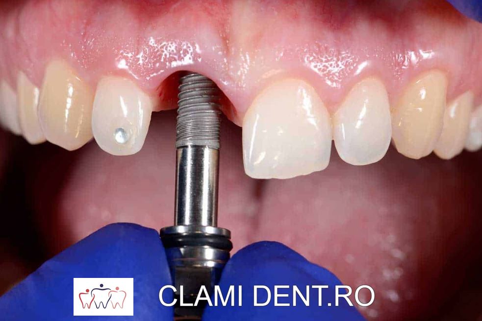 Implanturi Dentare Clinica Stomatologică Clamident Alba Iulia