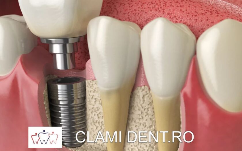 Implanturi Dentare Estetice
