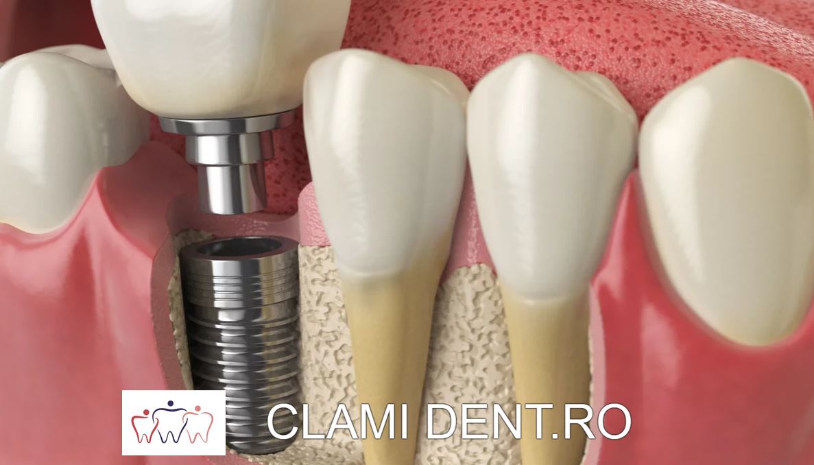 Implanturi Dentare Estetice