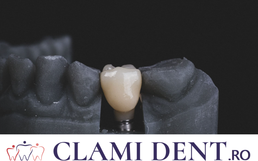 Îngrijirea Implanturile dentare reprezintă o revoluție în restaurarea zâmbetelor și sunt o investiție în sănătatea orală pe termen lung. La Clami Dent din Alba Iulia