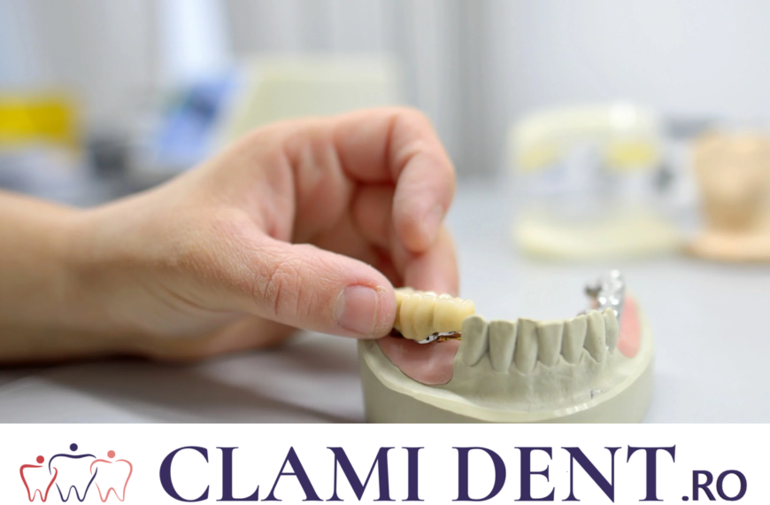 Întrebări Frecvente implanturilor dentare Alba Iulia Clinica Stomatologica ClamiDent