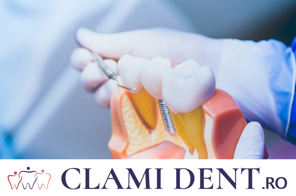 Întrebări Frecvente Implanturile dentare 