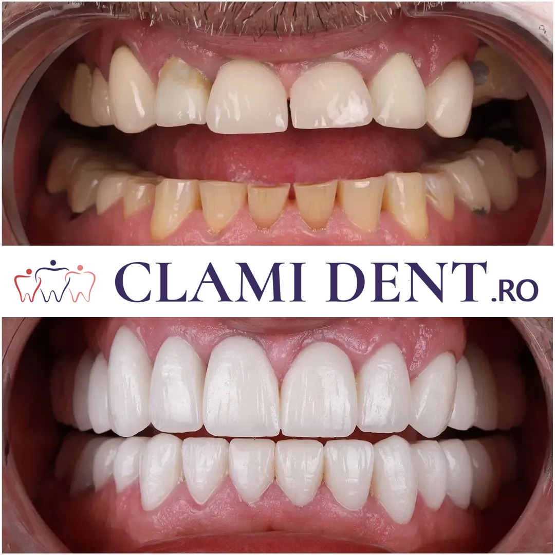 Preț implant dentar