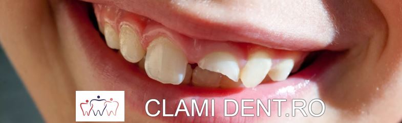 Repararea Dinților Fracturați sau Ciobiți