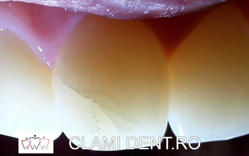 Reparația Fisurilor Dentare la Clinica Stomatologică Clamident din Alba Iulia