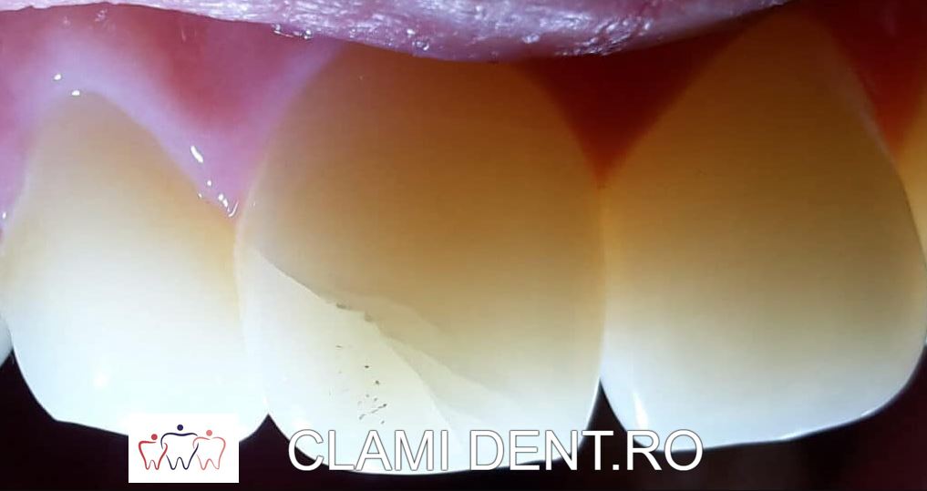 Reparația Fisurilor Dentare