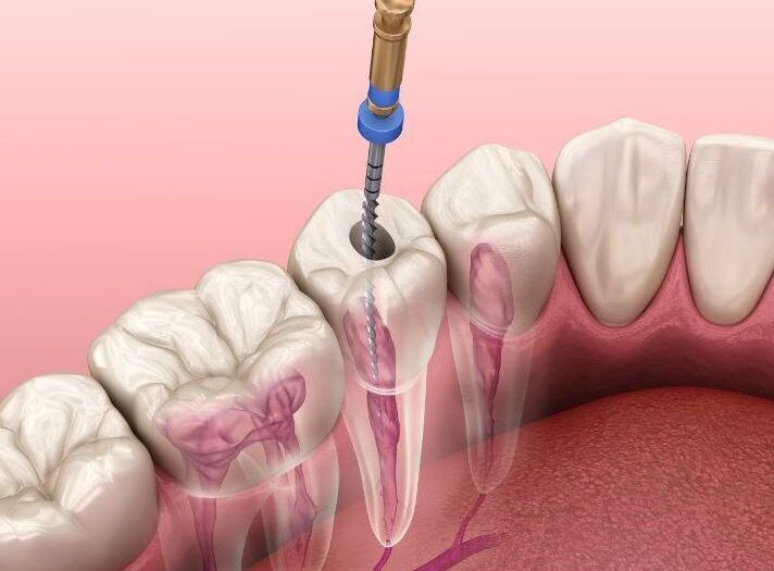 Retratamentul endodontic