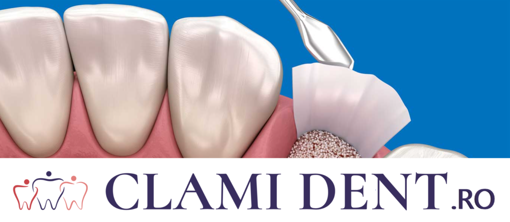 Succesul Implanturilor Dentare Alba Iulia Clinica Stomatologica ClamiDent