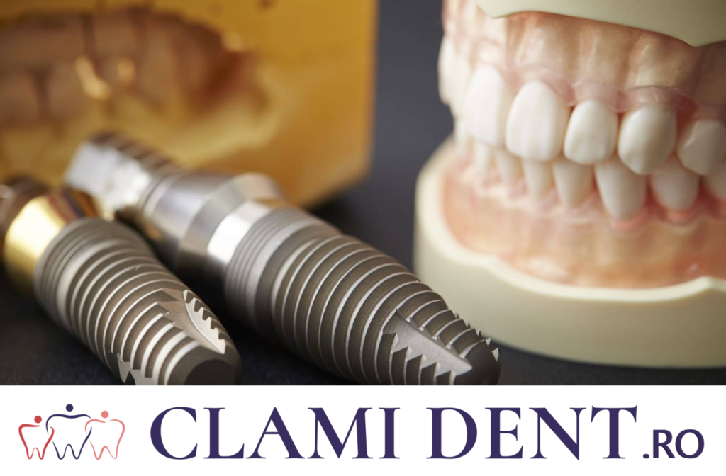 Succesul Implanturilor Dentare Alba Iulia Clinica Stomatologica ClamiDent