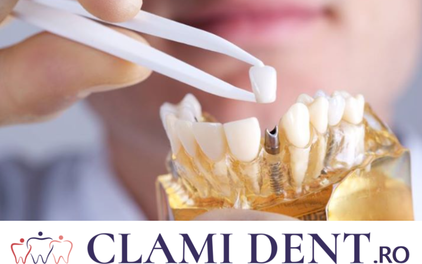 Totul Despre Implanturile Dentare Alba Iulia Clinica Stomatologica ClamiDent