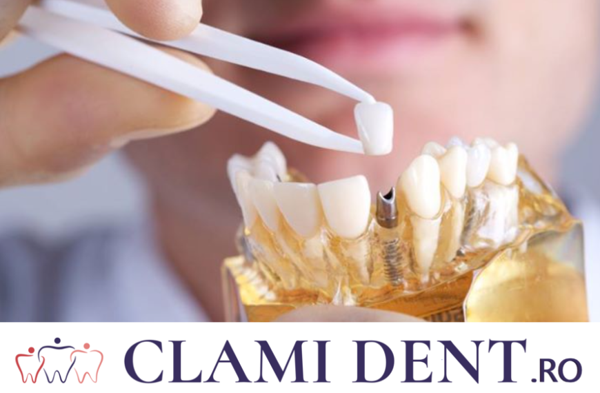 Totul Despre Implanturile Dentare Alba Iulia Clinica Stomatologica ClamiDent