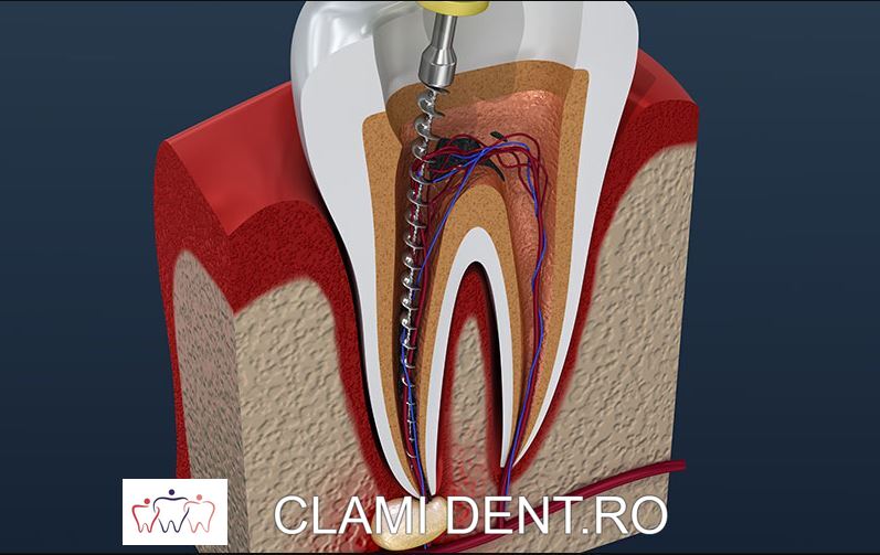 Tratamentul de canal endodontic