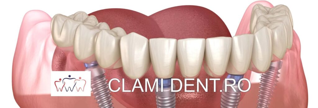 Implantul dentar All-on-4