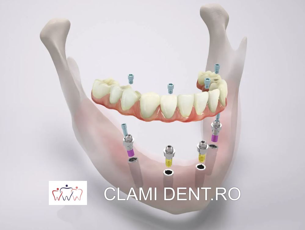 Implantul dentar All-on-4
