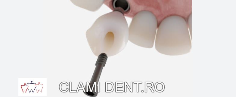 Implanturi Dentare Alba Iulia