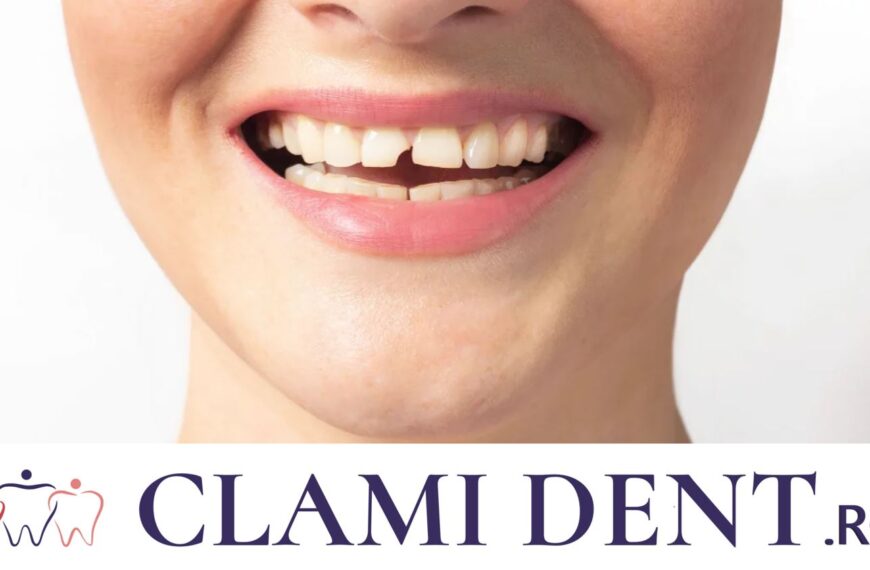 Bonding Dentar Alba Iulia ClamiDent