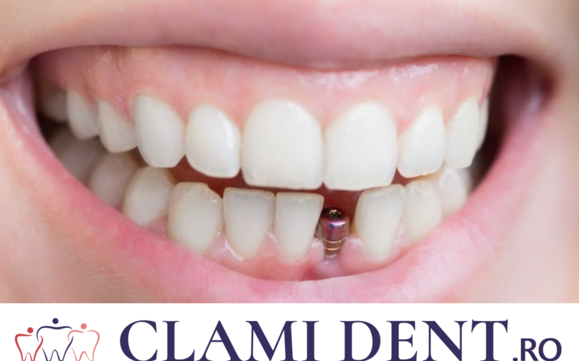 Care sunt Riscurile Implantului Dentar? Alba Iulia Clinica Stomatologica ClamiDent