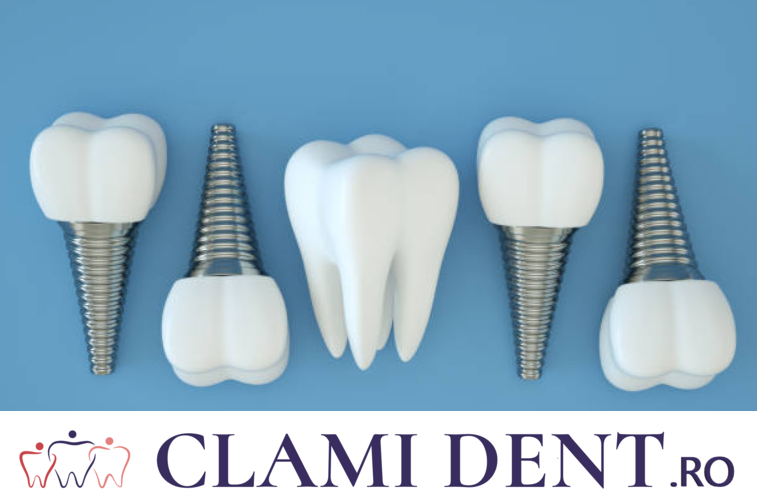Ce Probleme pot aparea la Implanturile Dentare și Cum Să le Eviti  Alba Iulia Clinica Stomatologica ClamiDent