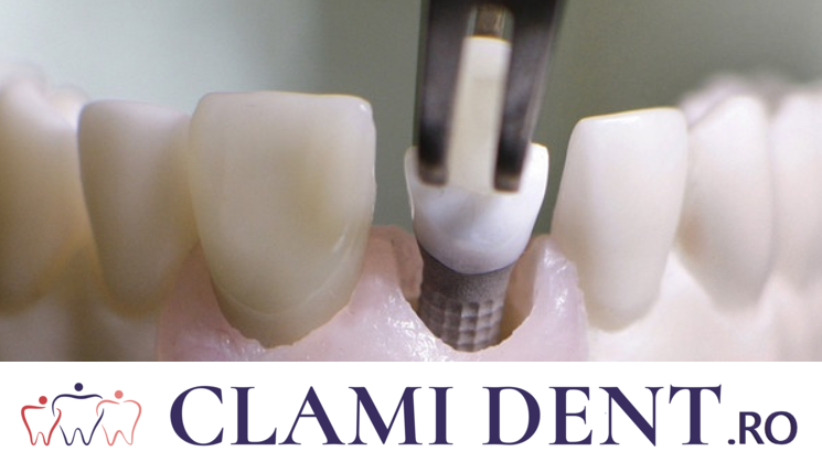 Cine este Candidatul Ideal pentru Implanturile Dentare Alba Iulia Clinica Stomatologica ClamiDent