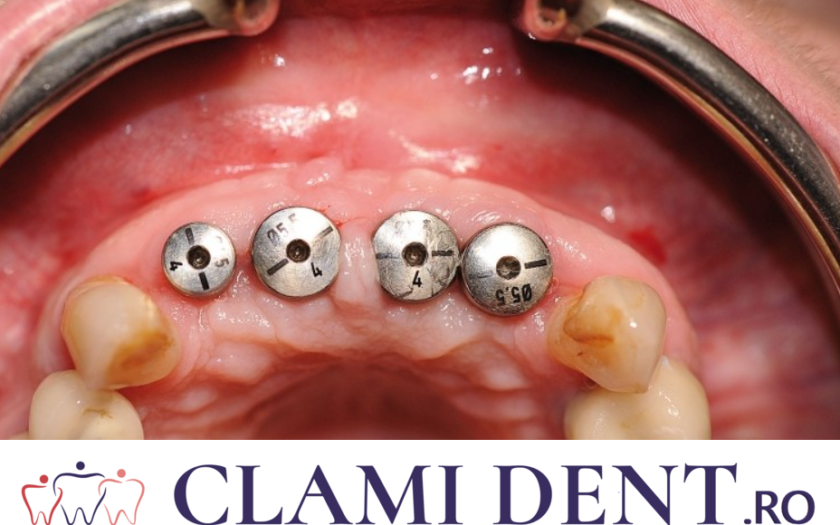 Cum Să Te Pregătești Pentru Un Implant Dentar la Clinica Stomatologică Clami Dent din Alba Iulia