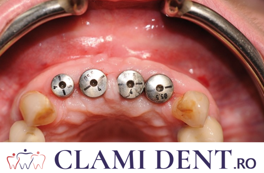 Cum Să Te Pregătești Pentru Un Implant Dentar la Clinica Stomatologică Clami Dent din Alba Iulia