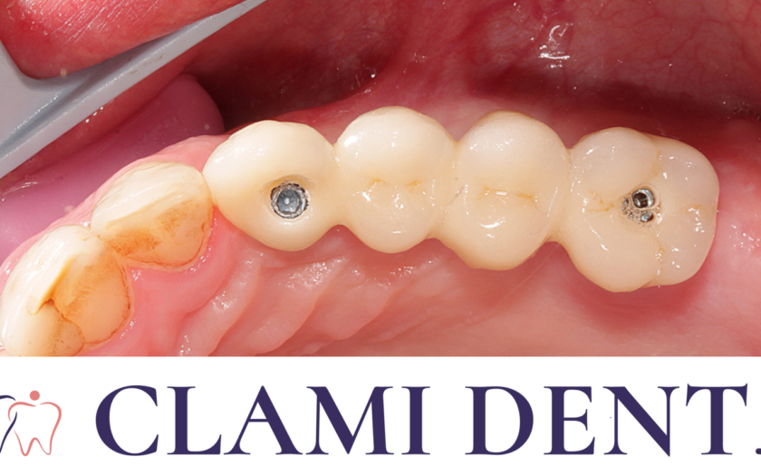 De Ce Să Alegi Implanturile Dentare alte Opțiuni Alba Iulia Clinica Stomatologica ClamiDent