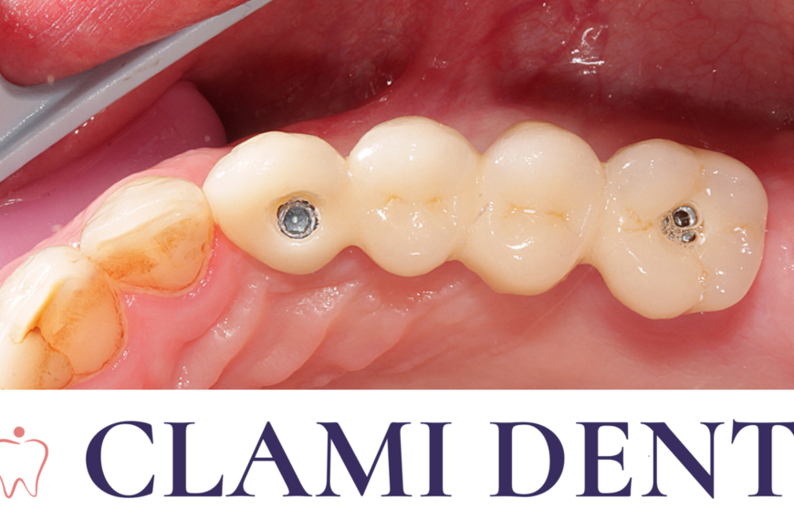 De Ce Să Alegi Implanturile Dentare alte Opțiuni Alba Iulia Clinica Stomatologica ClamiDent