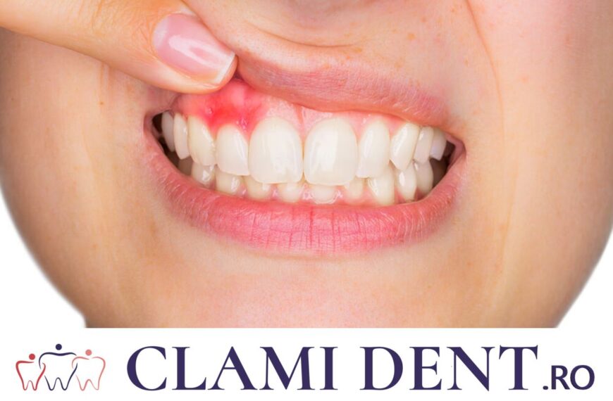 Gingivită Alba Iulia Clami Dent