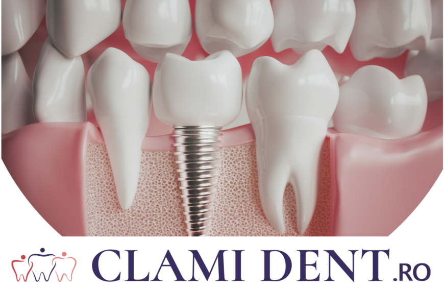 Implant Dentar Alba Iulia