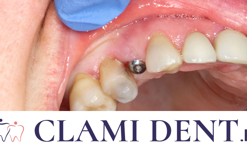 Implanturile Dentare Soluția Modernă pentru Pierderea Dinților la Clinica Stomatologică Clami Dent din Alba Iulia