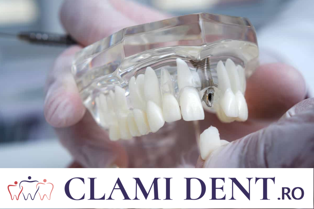 Implanturile Dentare și Alte Tratamente Restaurative la Clinica Stomatologică Clami Dent din Alba Iulia