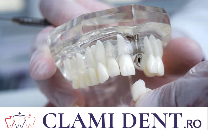 Implanturile Dentare și Alte Tratamente Restaurative la Clinica Stomatologică Clami Dent din Alba Iulia