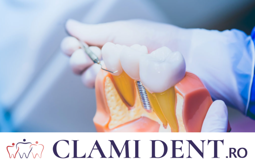 Mituri Despre Implanturile Dentare Alba Iulia Clinica Stomatologica Clami Dent