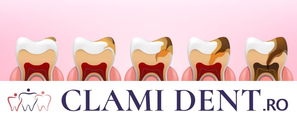 Plombe Alba Iulia Clinica Stomatologica Clami Dent 