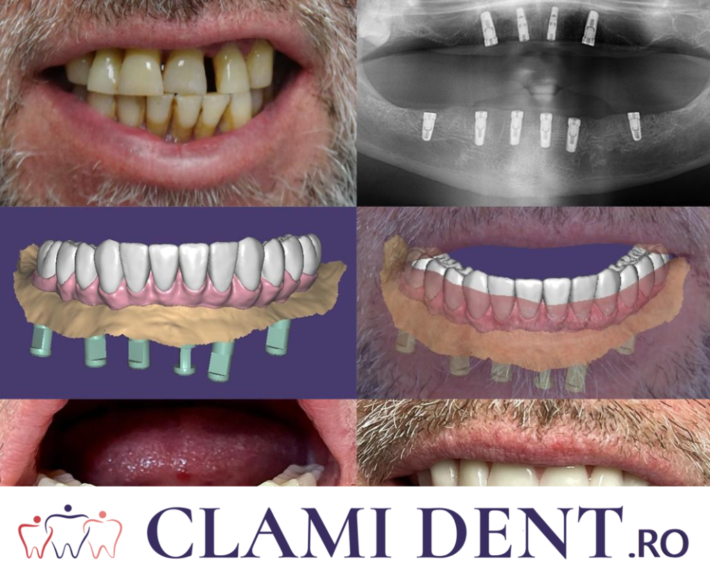 Procesul Pas cu Pas al Implantării Dentare la Clami Dent, Alba Iulia