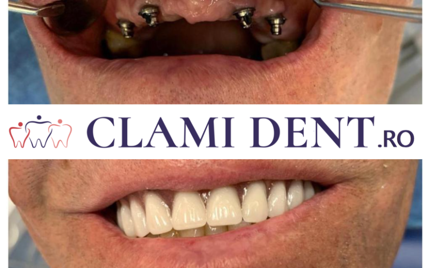 Procesul Pas cu Pas al Implantării Dentare Clami Dent Alba Iulia