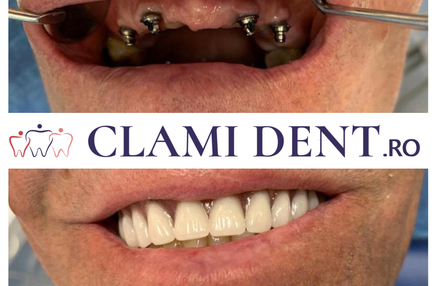 Procesul Pas cu Pas al Implantării Dentare Clami Dent Alba Iulia