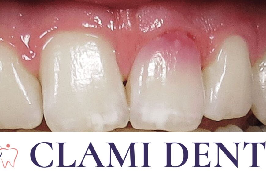 Resorbția Dentară Alba Iulia Clami Dent