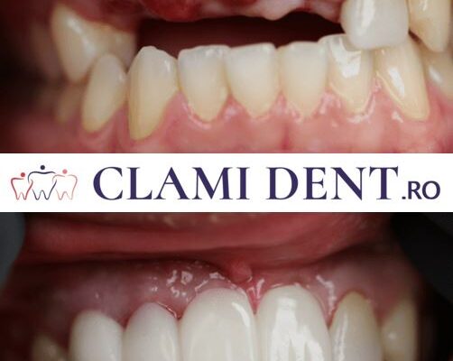 Transformă-ți Zâmbetul cu Implanturi Dentare la Clami Dent