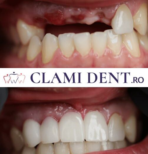 Transformă-ți Zâmbetul cu Implanturi Dentare la Clami Dent