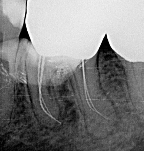 Succesul Tratamentului de Canal Alba Iulia